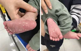 Ngỡ ngàng phát hiện con mới 46 ngày tuổi đã mắc bệnh... giang mai