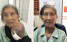 Giải thoát cụ bà 85 tuổi khỏi khối u khổng lồ ở cổ phải chung sống suốt 40 năm