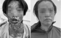 Người phụ nữ bị suy thận cấp, tổn thương da nặng do tự ý dùng thuốc