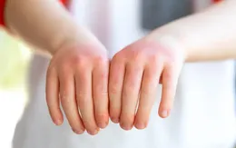 Các triệu chứng sốc nhiệt ở trẻ em và cách phòng tránh sớm