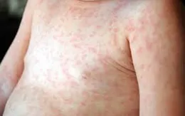 Chăm sóc trẻ mắc sốt xuất huyết Dengue tại nhà