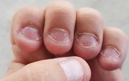 Thói quen cắn móng tay và những ẩn họa khôn lường