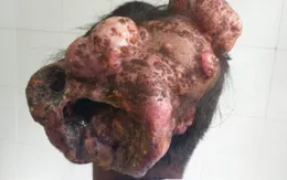 Phẫu thuật khối u khổng lồ vùng đầu cho bệnh nhân nhiễm HIV
