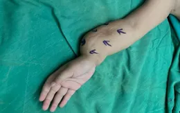 Bé gái 5 tuổi mắc bệnh khớp giả bẩm sinh 2 xương cẳng tay cực hiếm gặp