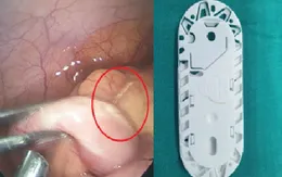 Ca bệnh hiếm gặp: Xương cá đâm thủng ruột thừa