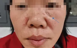 Tái phát ung thư da sau khi điều trị ở cơ sở y tế không chuyên khoa