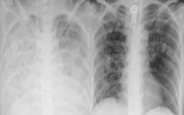Tự điều trị cúm, bệnh nhân phải can thiệp ECMO do viêm phổi bội nhiễm