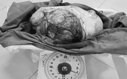 Đi khám vì thấy bụng to nhanh, bệnh nhân phát hiện khối u buồng trứng nặng 6,5kg
