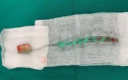 Nhập viện cấp cứu vì nuốt... bàn chải đánh răng