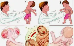 Bé 4 tháng tuổi bị chảy máu não nghi do bị chuyền tay nhau bế và rung lắc