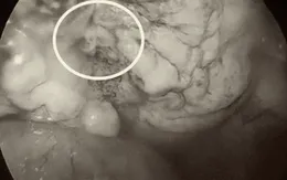 Trượt chân ngã trong nhà tắm, 3 ngày sau nhập viện cấp cứu vì vỡ bàng quang