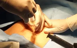 Truyền ối - Giải pháp tối ưu cho thai phụ bị thiểu ối