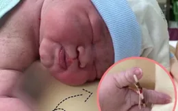 Bé gái chào đời cùng vòng tránh thai của mẹ