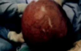 Ngỡ béo bụng, người phụ đi khám phát hiện khối u nặng gần 10kg
