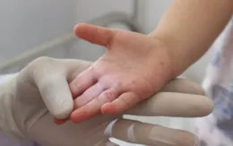 Cả nước ghi nhận hơn 5.200 ca mắc tay chân miệng trong tuần qua