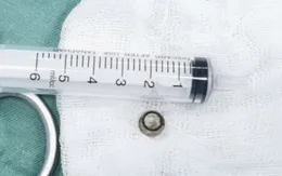 Bé 8 tuổi cấp cứu vì viên pin rơi vào phổi