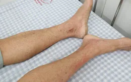 Cảnh báo gia tăng số ca bệnh sốt xuất huyết