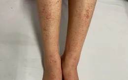 TP. Hồ Chí Minh: Số ca mắc tay chân miệng, sốt xuất huyết tăng trở lại