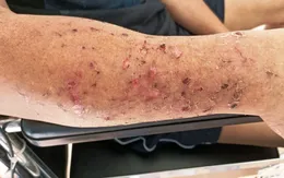 Hiếm gặp: Bệnh nhân bị rối loạn tâm thần sau đột quỵ não