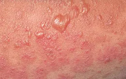 Cảnh báo: Dùng thuốc không rõ nguồn gốc, bệnh nhân mắc hội chứng hiếm gặp