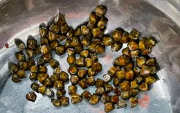 113 viên sỏi lấp đầy túi mật bệnh nhân