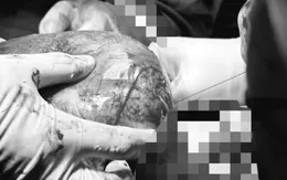 Mổ lấy thai kết hợp bóc đa u xơ tử cung cho sản phụ