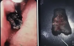 Nhập viện vì uống thuốc quên bóc vỏ, hóc xương