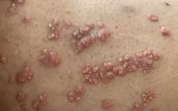 U nổi khắp người do rối loạn mỡ máu