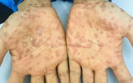 Phát hiện mắc giang mai sau hơn 2 tháng quan hệ tình dục không an toàn