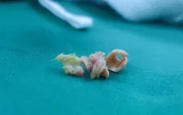 Bóc mảng xơ vữa gây hẹp động mạch cảnh