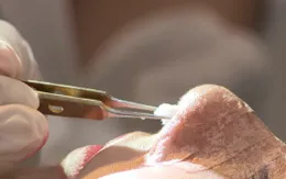 Hậu phẫu thuật nâng mũi, bác sĩ thẩm mỹ cảnh báo dấu hiệu bất thường