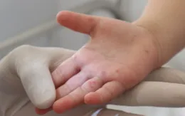 Đắk Lắk: Bệnh nhi 2 tuổi tử vong vì bệnh tay chân miệng
