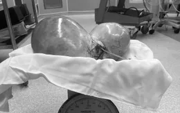 Thấy bụng to lên bất thường, đi khám mổ ra khối u nặng hơn 5kg