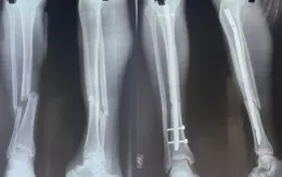 Gãy 2 xương cẳng chân sau va chạm khi đá bóng