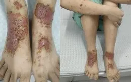 Phòng ngừa viêm da cơ địa thời điểm giao mùa