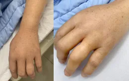 Truyền 6 lọ huyết thanh kịp thời cứu bệnh nhân bị rắn độc cắn