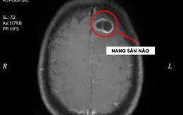 Phát hiện nang sán trong não do thói quen ăn tiết canh