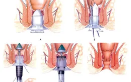 Chảy máu - biến chứng nguy hiểm của bệnh trĩ