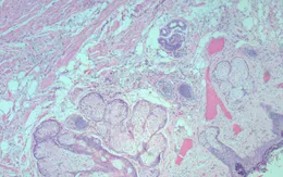 Ca bệnh hiếm gặp: Polyp lông ở trẻ sơ sinh