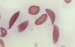 Anh phê duyệt liệu pháp gen điều trị bệnh hồng cầu hình liềm đầu tiên trên thế giới