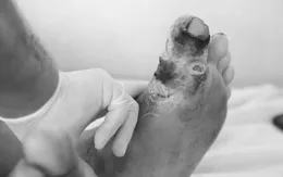 Phát hiện sớm đái tháo đường type 2 để tránh các biến chứng