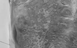 Cảnh giác nguy cơ dị ứng thuốc nặng sau điều trị bằng thuốc nam