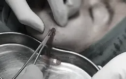 Thêm nhiều bệnh nhân bị biến chứng sau khi tiêm filler