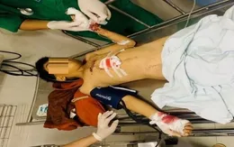 Bé trai bị đa chấn thương do nổ pin