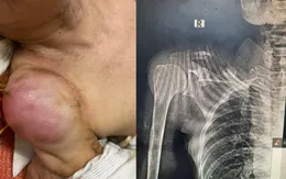 Cảnh báo biến chứng nặng do sử dụng thuốc nam không đúng cách
