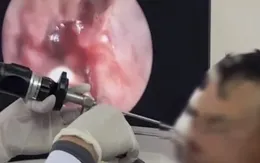 Gắp hơn 100 con giòi làm tổ trong hốc mũi bệnh nhân