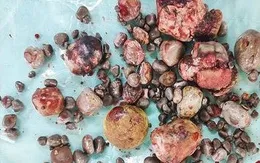 Lấy ra hơn 100 viên sỏi thận cho một bệnh nhân