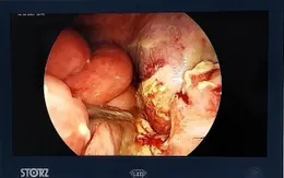 Cảnh báo tình trạng viêm ruột thừa đến muộn ở trẻ em
