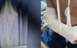 Bé trai bị thanh sắt đâm xuyên thủng tay khi qua xưởng sản xuất nui chơi