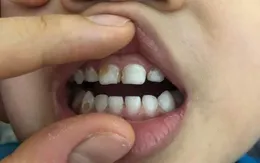 Bé trai sưng nề mặt sau điều trị đau răng tại phòng khám tư